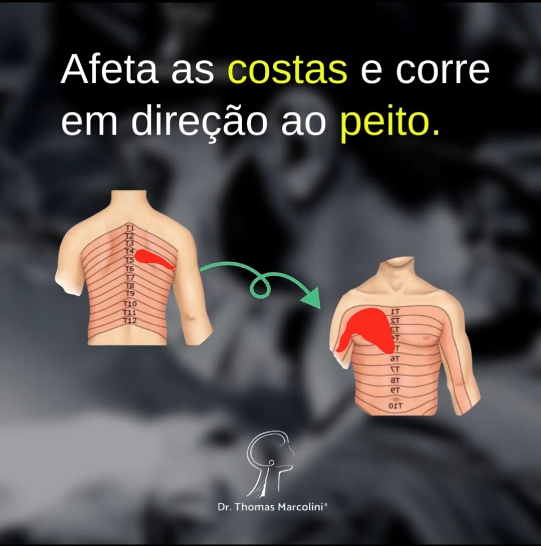 Queimação e choques nas costas para o peito pode ser neuropatia intercostal.