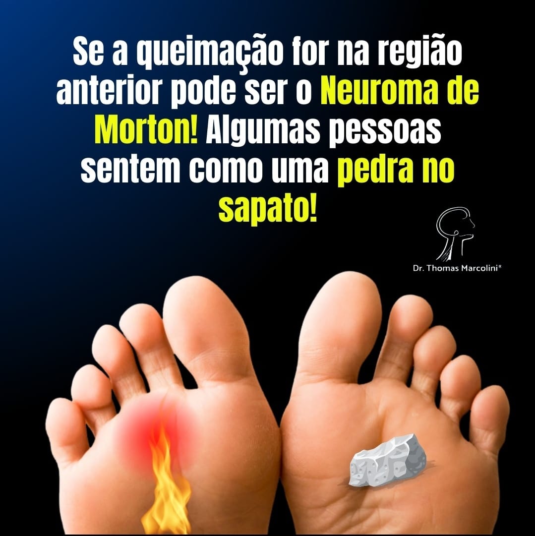 Neuroma de Morton causa queimação no pé.