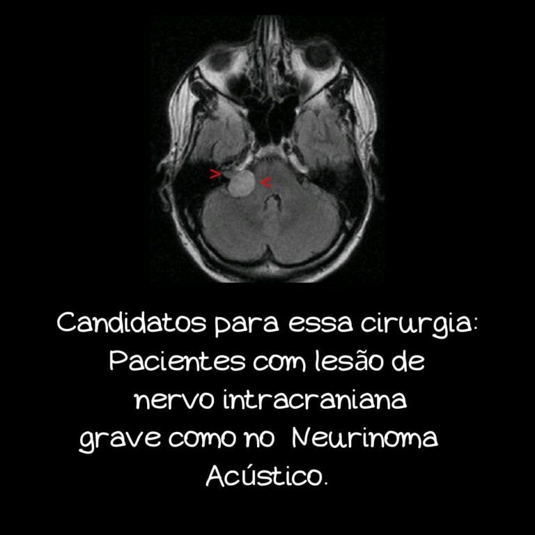 neutotização após lesão do facial em neurinoma do acústico