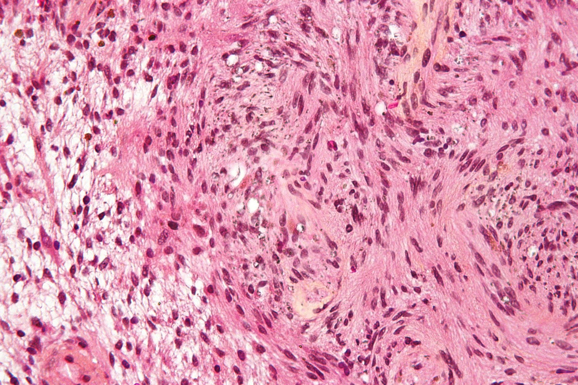 Médico para Schwannoma em São paulo capital.