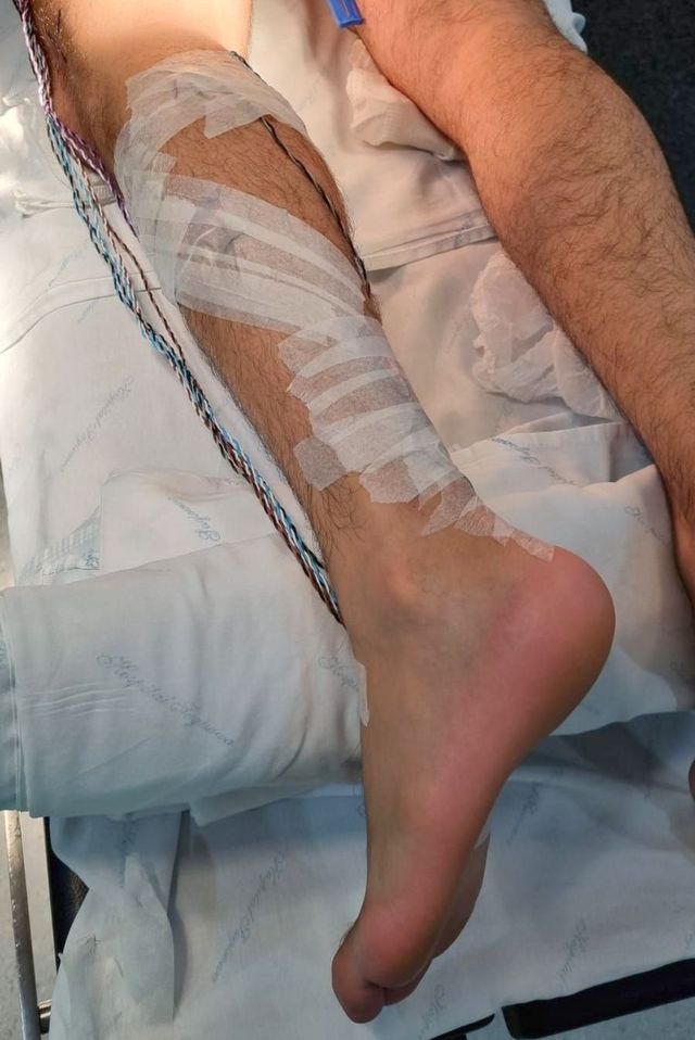 melanotan 2 injections does it work Love Island generation' skin cancer fear