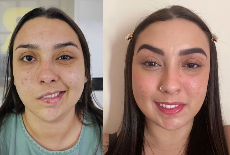 Nossa paciente com paralisia facial antes e depois da cirurgia.