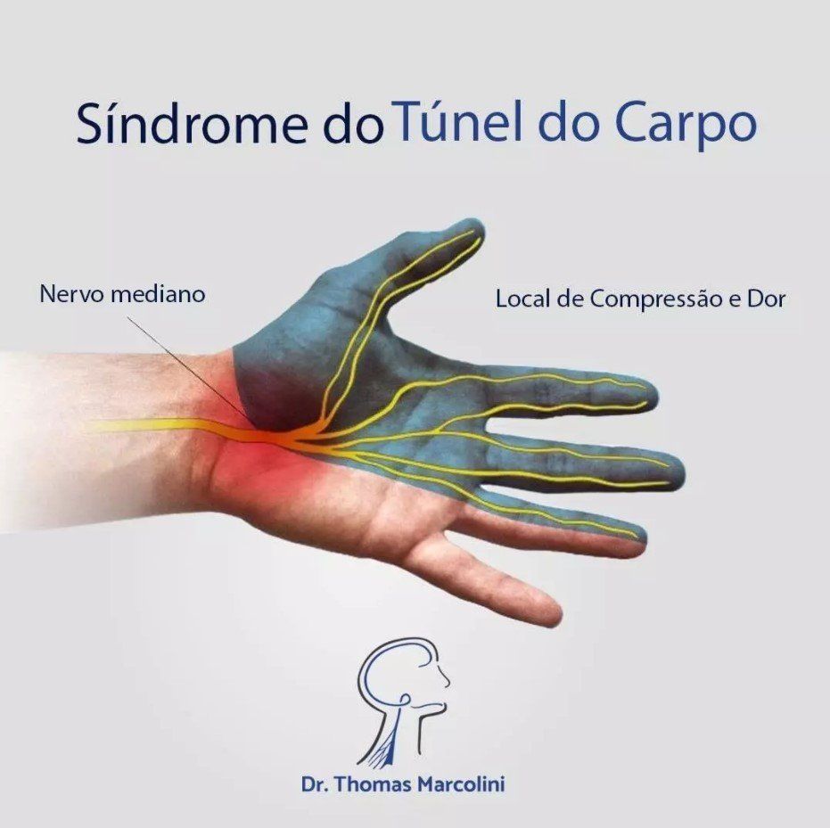 Síndrome Do Túnel Do Carpo formigamento nas mãos