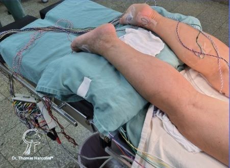 Quais são os sintomas de Schwannomas e Tumores de nervos periféricos?