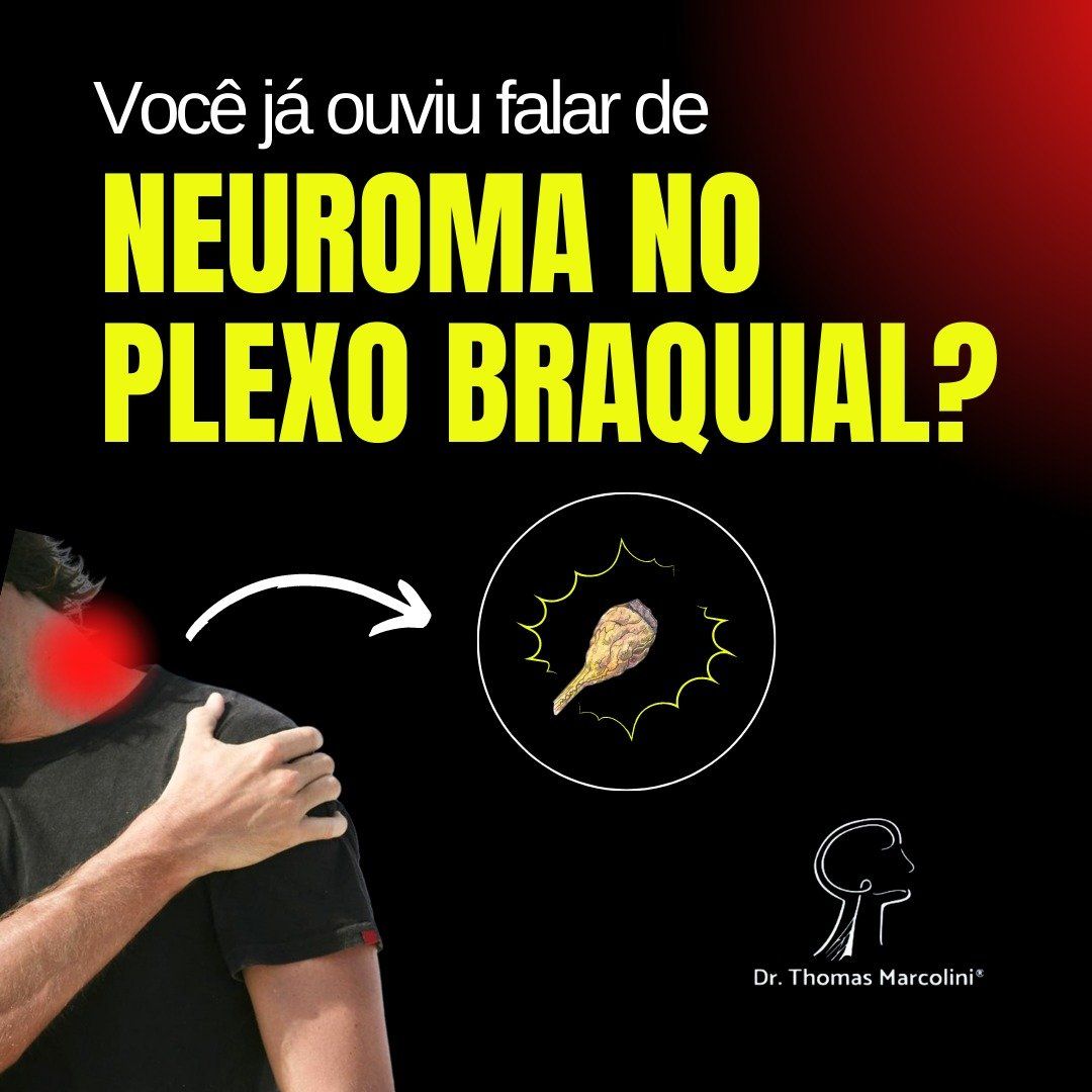 Neuroma de plexo braquial.