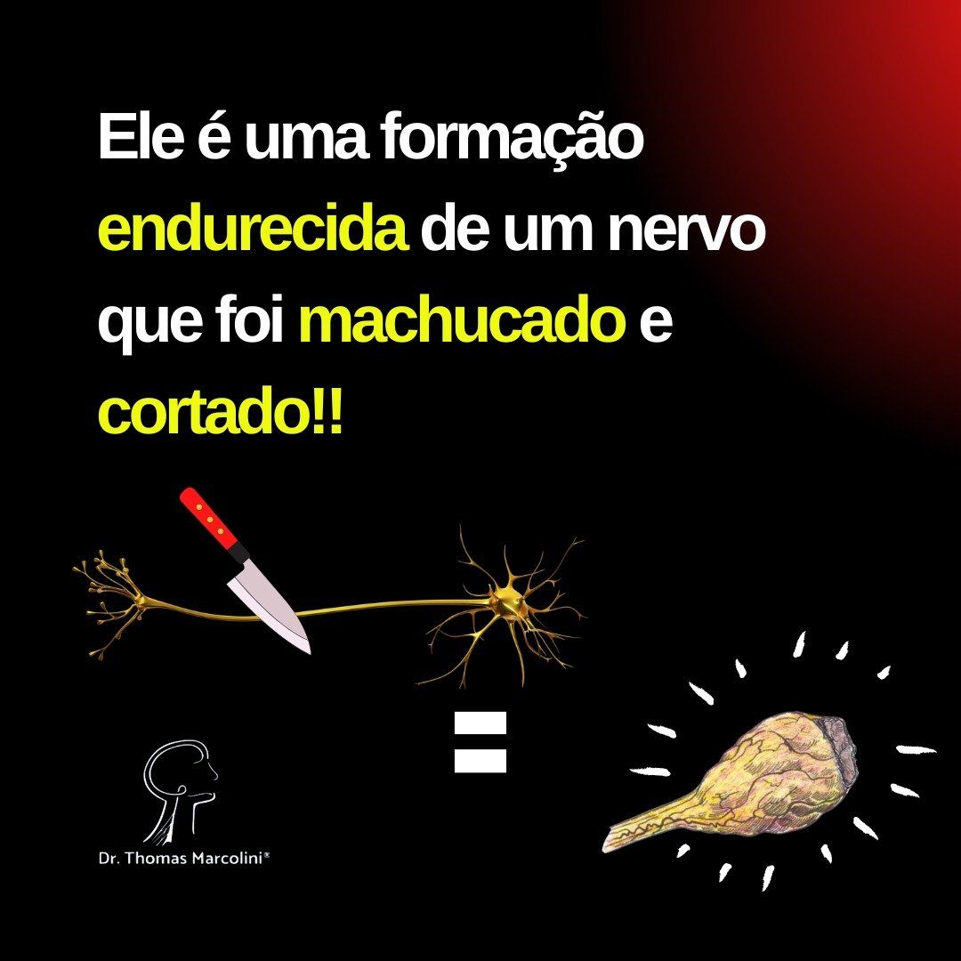 Como forma um neuroma.