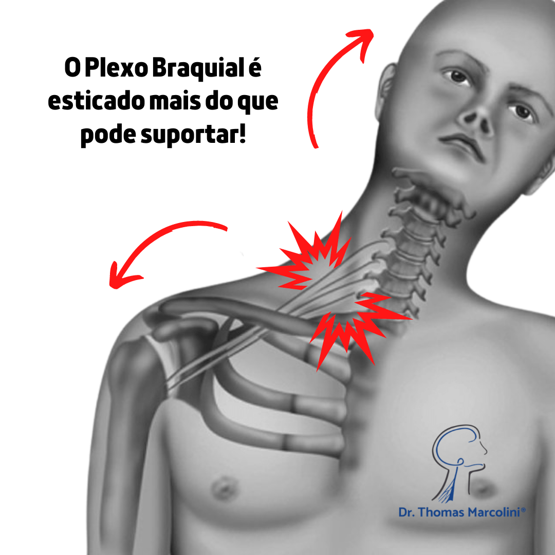 Cirurgia do plexo braquial