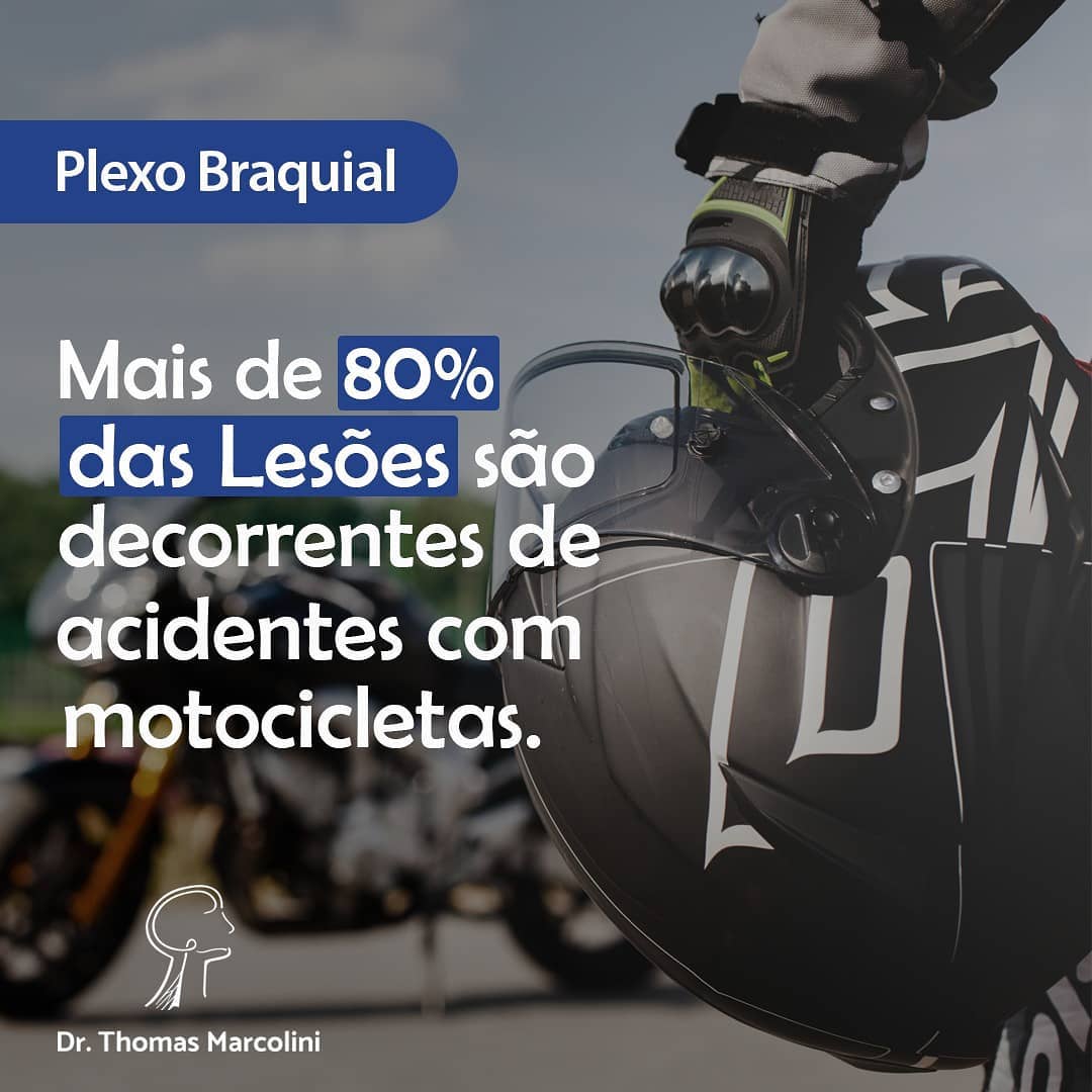 Plexo braquial causada por queda de moto