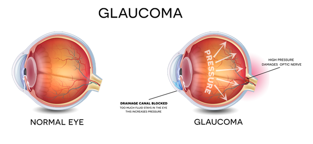 Lenti oftalmiche hot sale per glaucoma