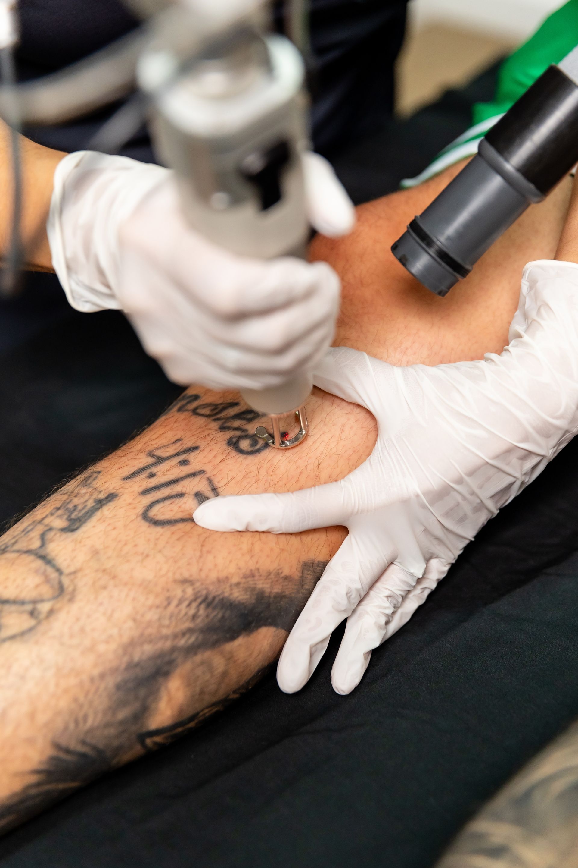 Laser tattoo removal on a person's leg, operator wearing gloves. Skin is exposed, and equipment is positioned over the tattoo.