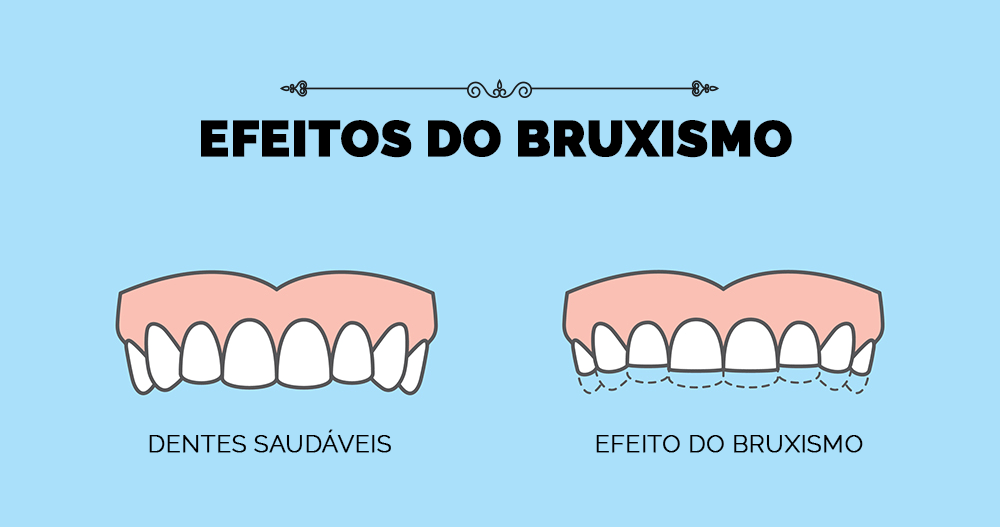 Placa para bruxismo defeituosa pode trazer problemas além dos dentes.