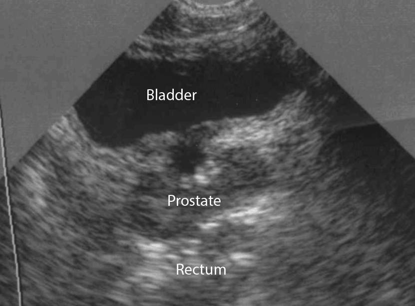 Ultrasound - BPH Treatment How it works