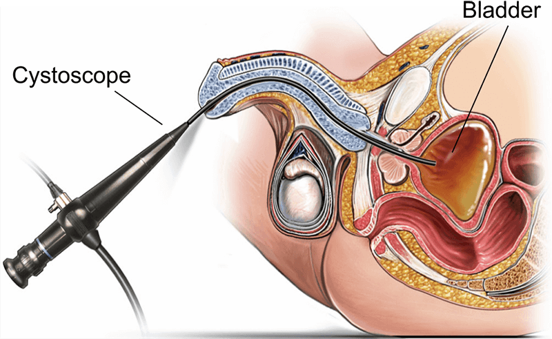 Penal Cystoscopy