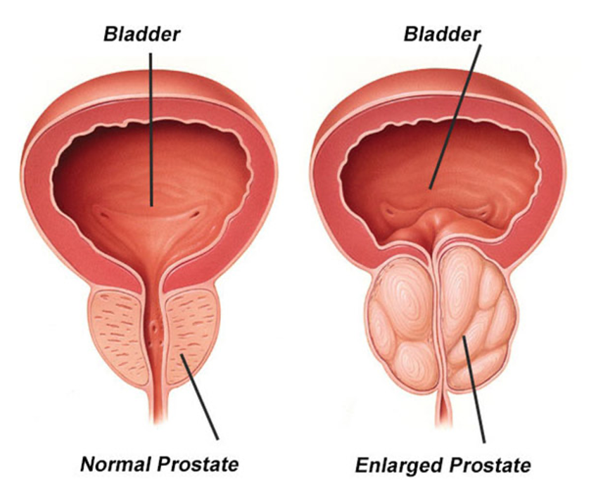 BPH Surgery Melbourne