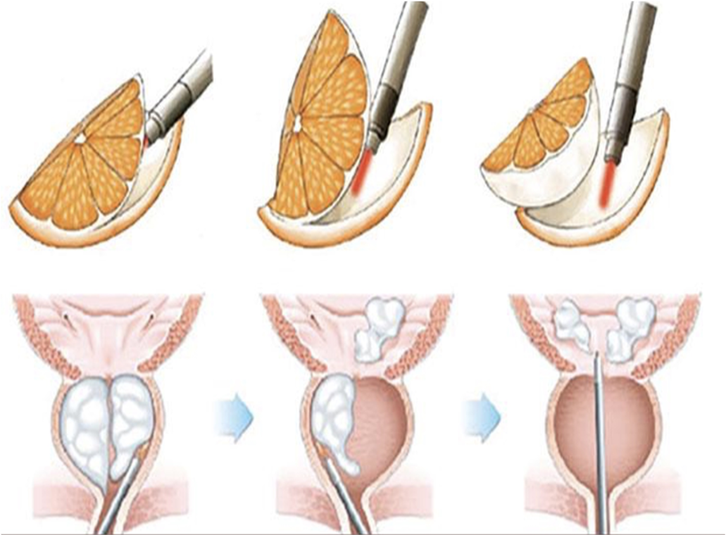 HoLEP for BPH Treatment 