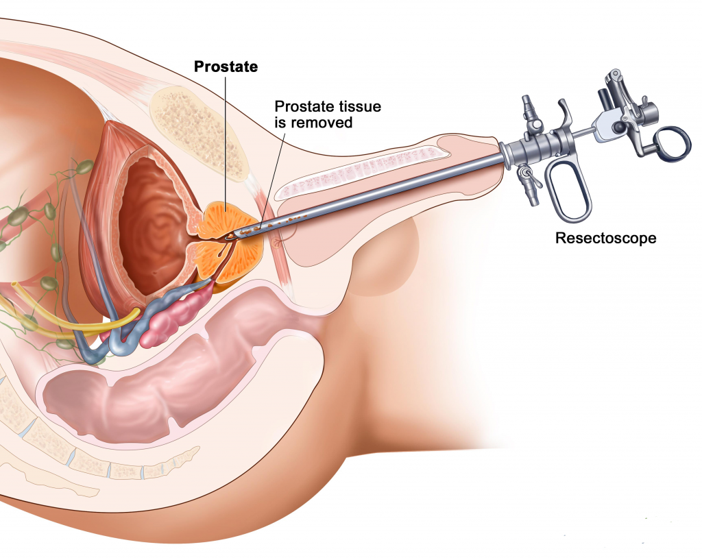 BPH Treatment How it works Melbourne