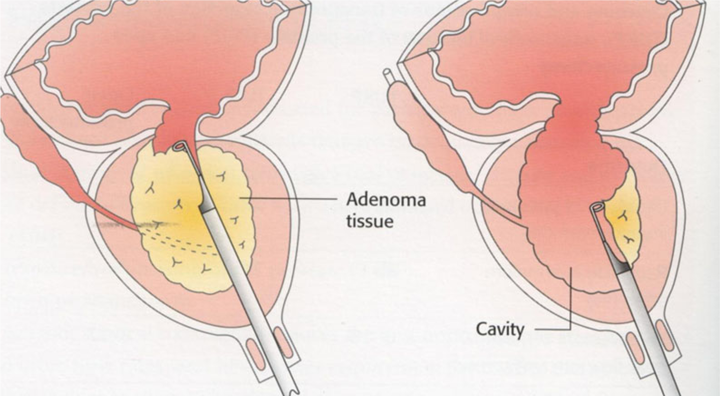 BPH Treatment How it works Melbourne