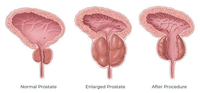 What is Enlarged Prostate