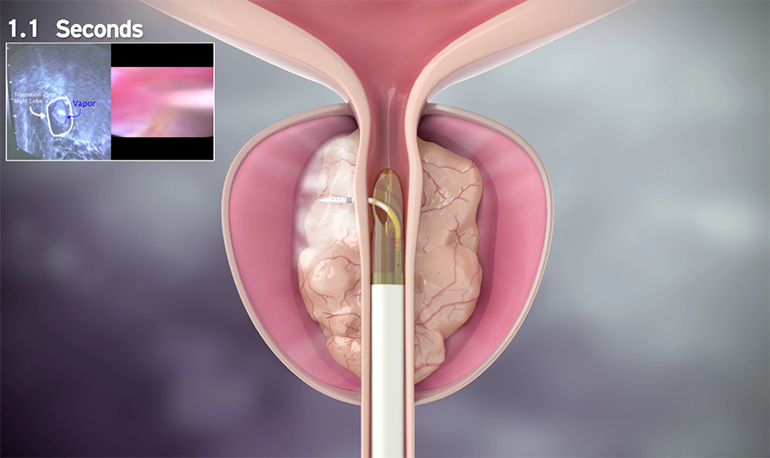 Rezum Therapy for BPH