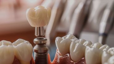 UNIDAD DE TOMOGRAFÍA DENTAL UTD - GUÍAS QUIRÚRGICAS PARA IMPLANTACIÓN