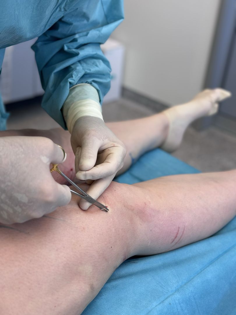 Ein Chirurg schneidet mit einer Schere eine Vene im Bein eines Patienten durch.