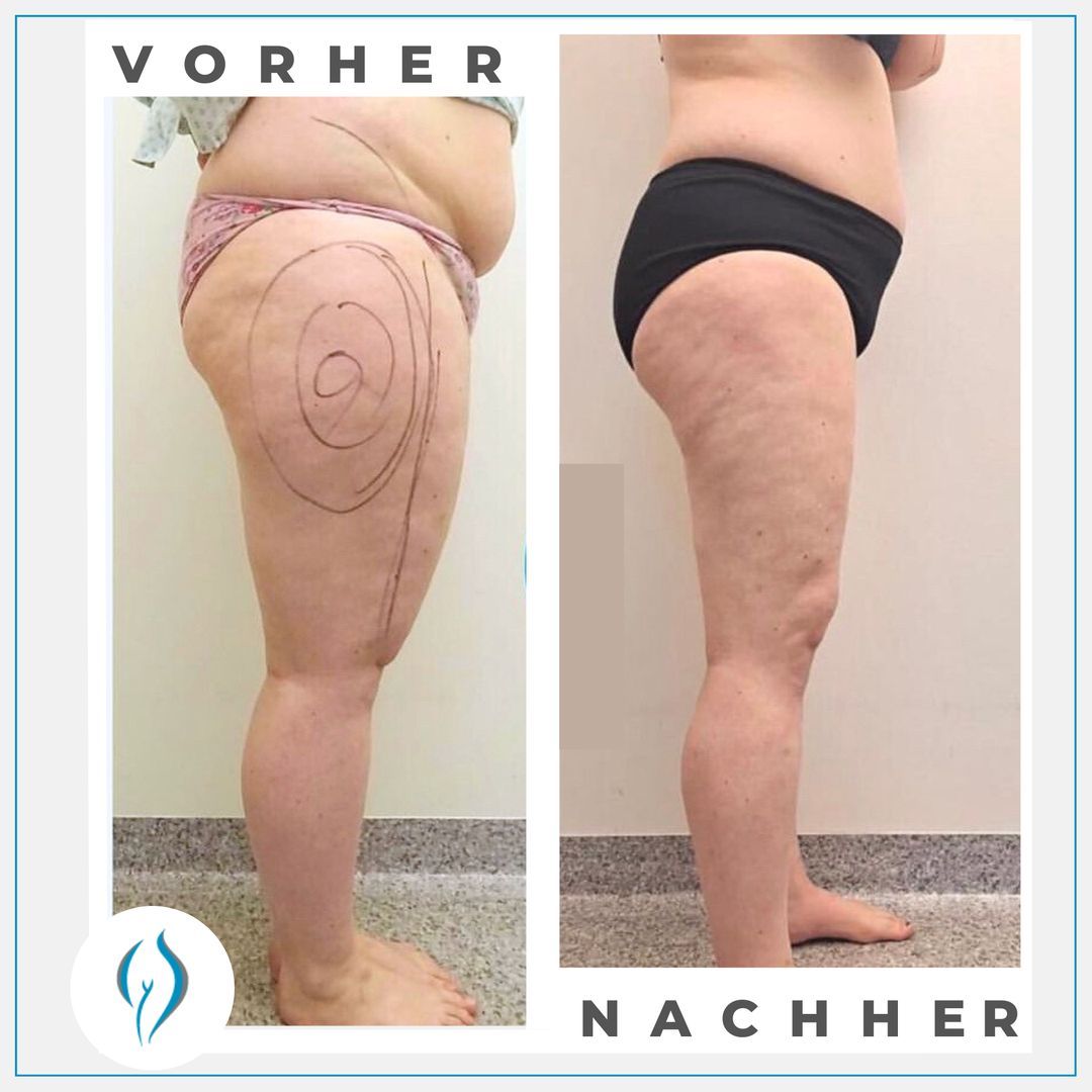 Bild Vorher-Nachher-Vergleich Po, Beine und Bauch seitlich nach Lipödem-Operation im LipoZentrum Dr. Heck