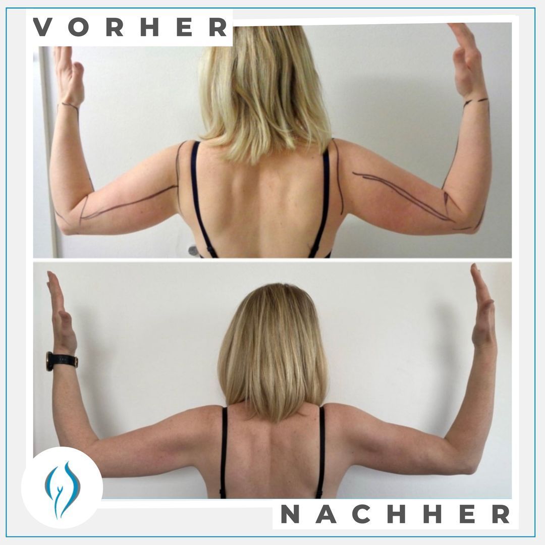 Bild Vorher-Nachher-Vergleich Arme von hinten nach Lipödem-Operation im LipoZentrum Dr. Heck