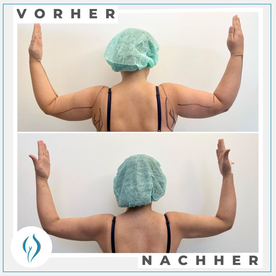 Bild Vorher-Nachher-Vergleich Arme von hinten nach Lipödem-Operation im LipoZentrum Dr. Heck
