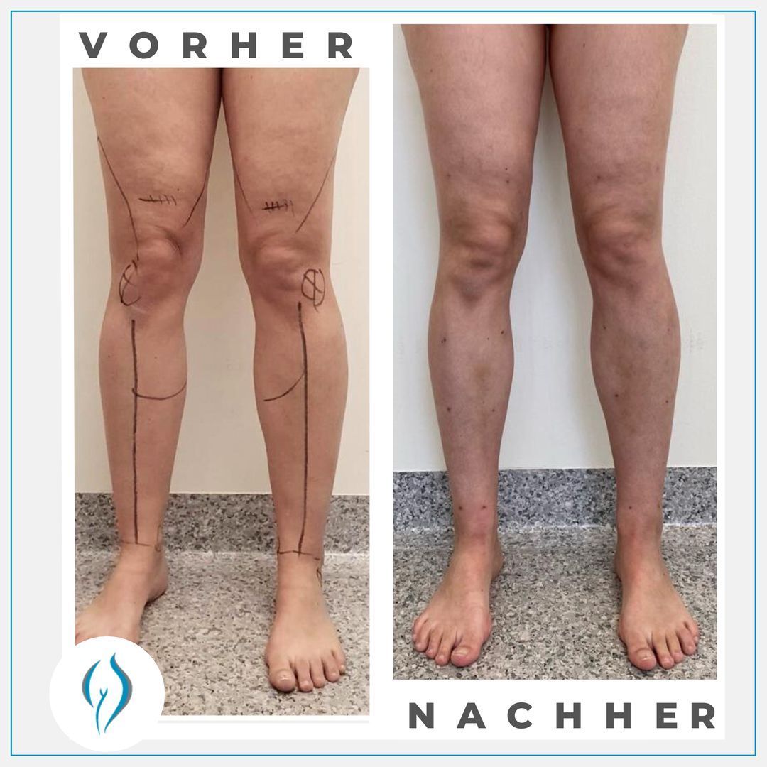 Bild Vorher-Nachher-Vergleich Beine von vorne nach Lipödem-Operation im LipoZentrum Dr. Heck