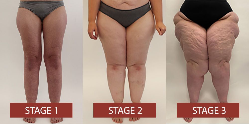 Stages of Lipedema