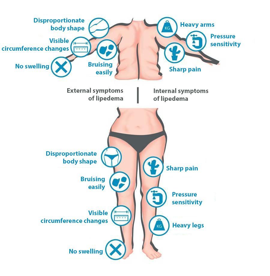 Diagram illustrating symptoms of lipedema on a person’s upper and lower body, including pain, bruising, and disproportionate body shape.