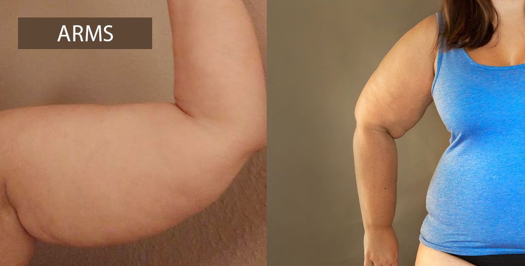 Two arms show different stages of lipedema. One arm is hold vertically, the other is by the side of a person wearing a blue tank top.