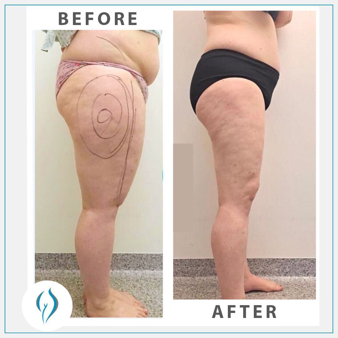 Comparison of a thigh before and after lipedema surgery.