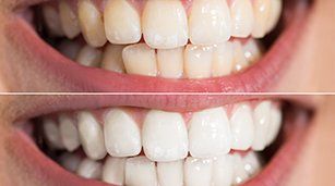 Teeth Whitening — Teeth Whitening Before and After in Redding, CA