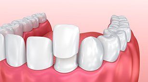 Cracked Tooth? Cosmetic Repair Options - Thanasas Family Dental