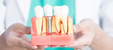 Implant Dentistry — Dentist Holding Teeth Sample in Redding, CA
