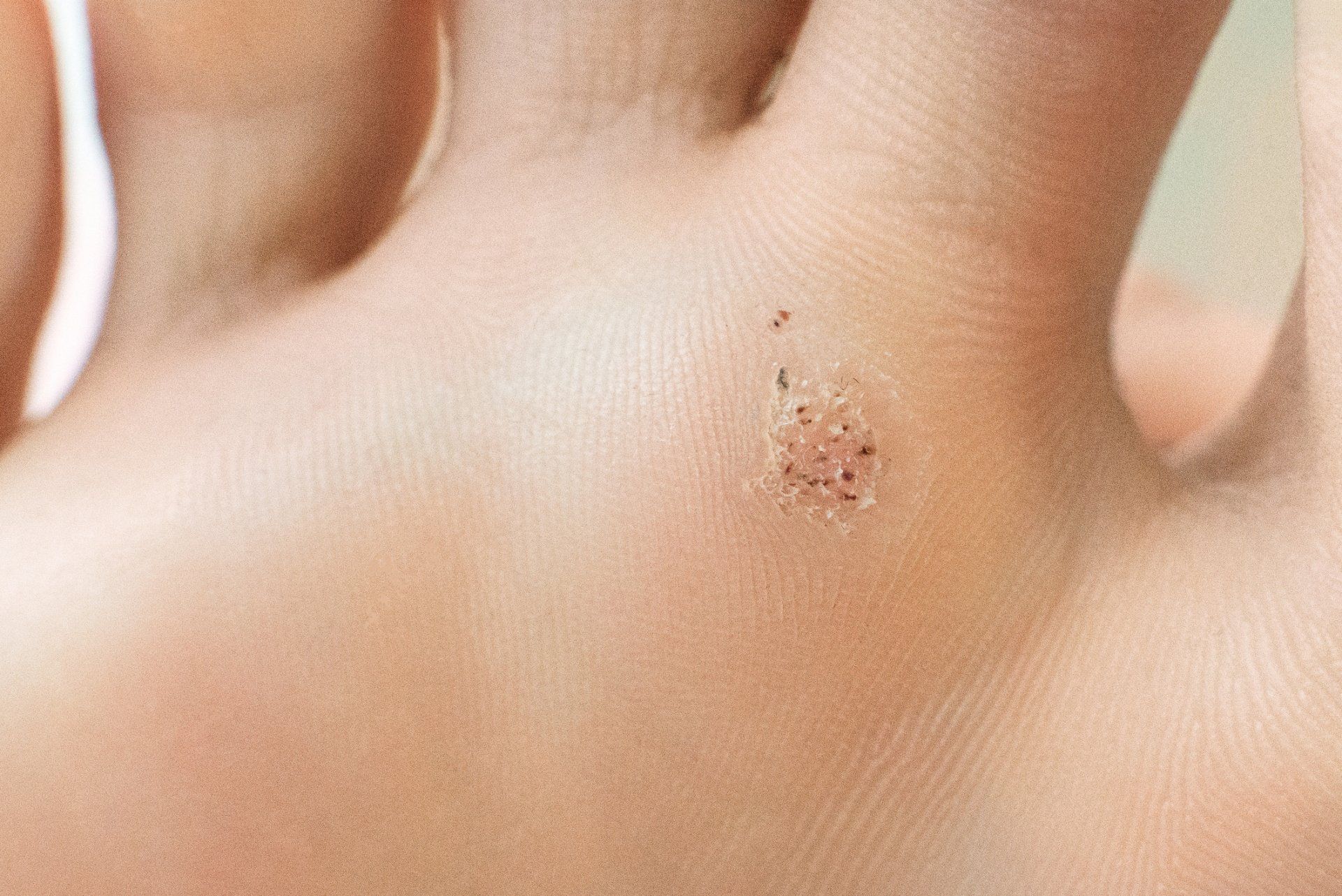 Wart On A Blunt — Farmington Hills, MI — Farmington Hills Dermatology