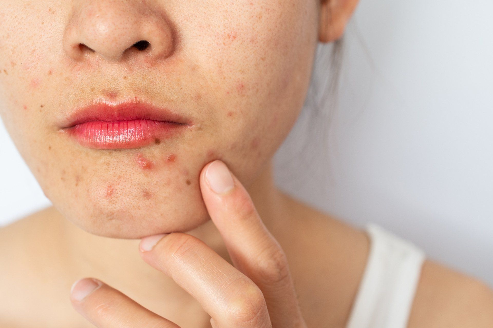 Asian Woman With Pimple And Acne — Farmington Hills, MI — Farmington Hills Dermatology
