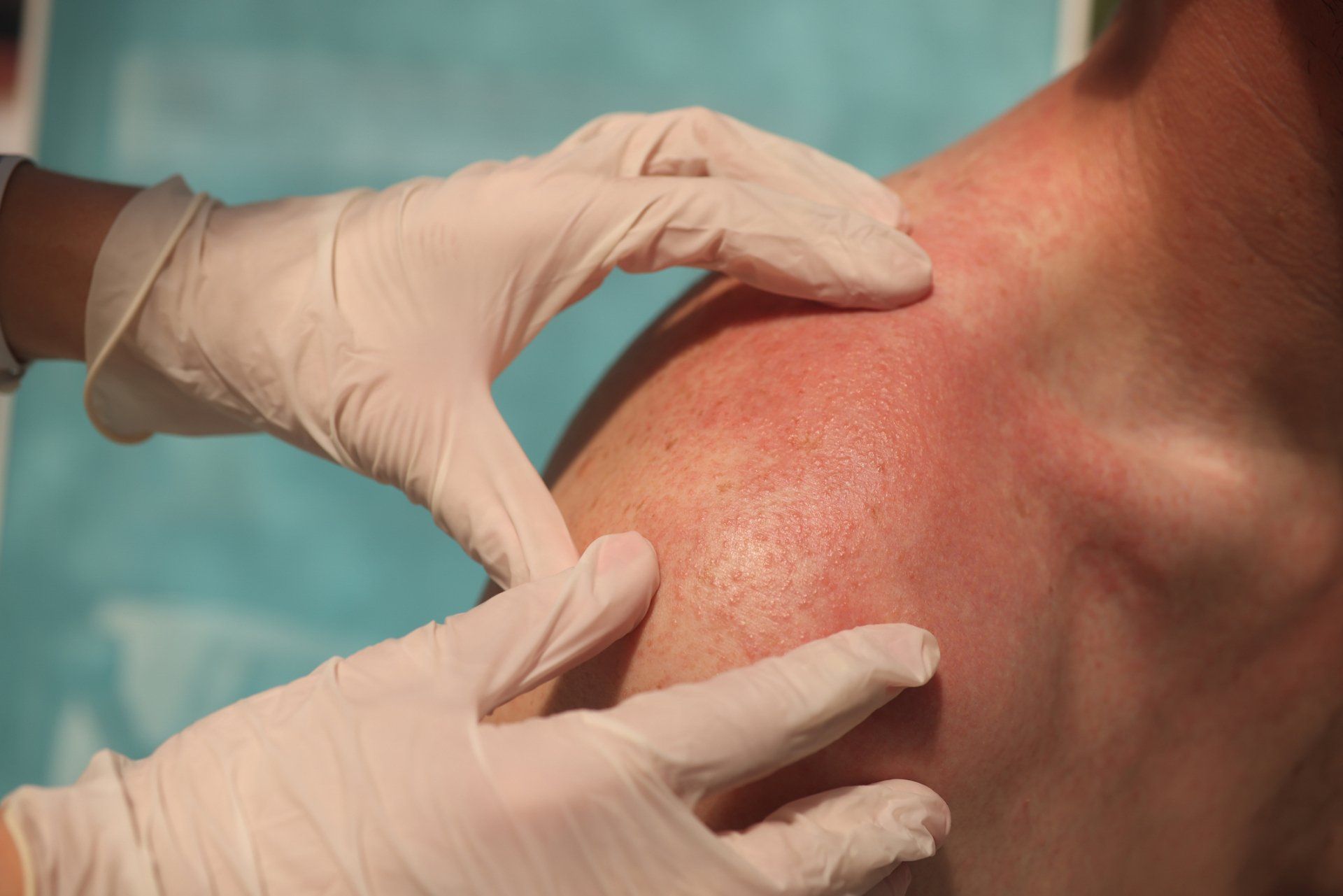 Rash On Skin Of Man Shoulders — Farmington Hills, MI — Farmington Hills Dermatology