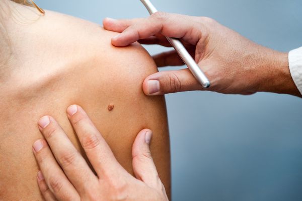 Inspecting Patient Skin Moles — Farmington Hills, MI — Farmington Hills Dermatology