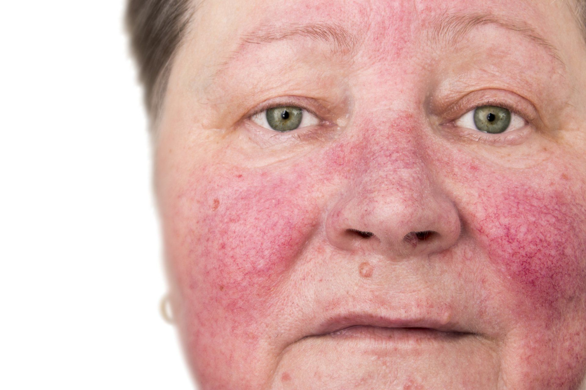 Elderly Woman With Rosacea — Farmington Hills, MI — Farmington Hills Dermatology