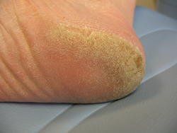 Een deelbehandeling kan ook zijn dat alleen het eelt wordt verwijderd