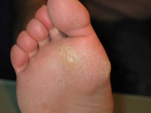 Likdoorns zijn veel voorkomende klachten