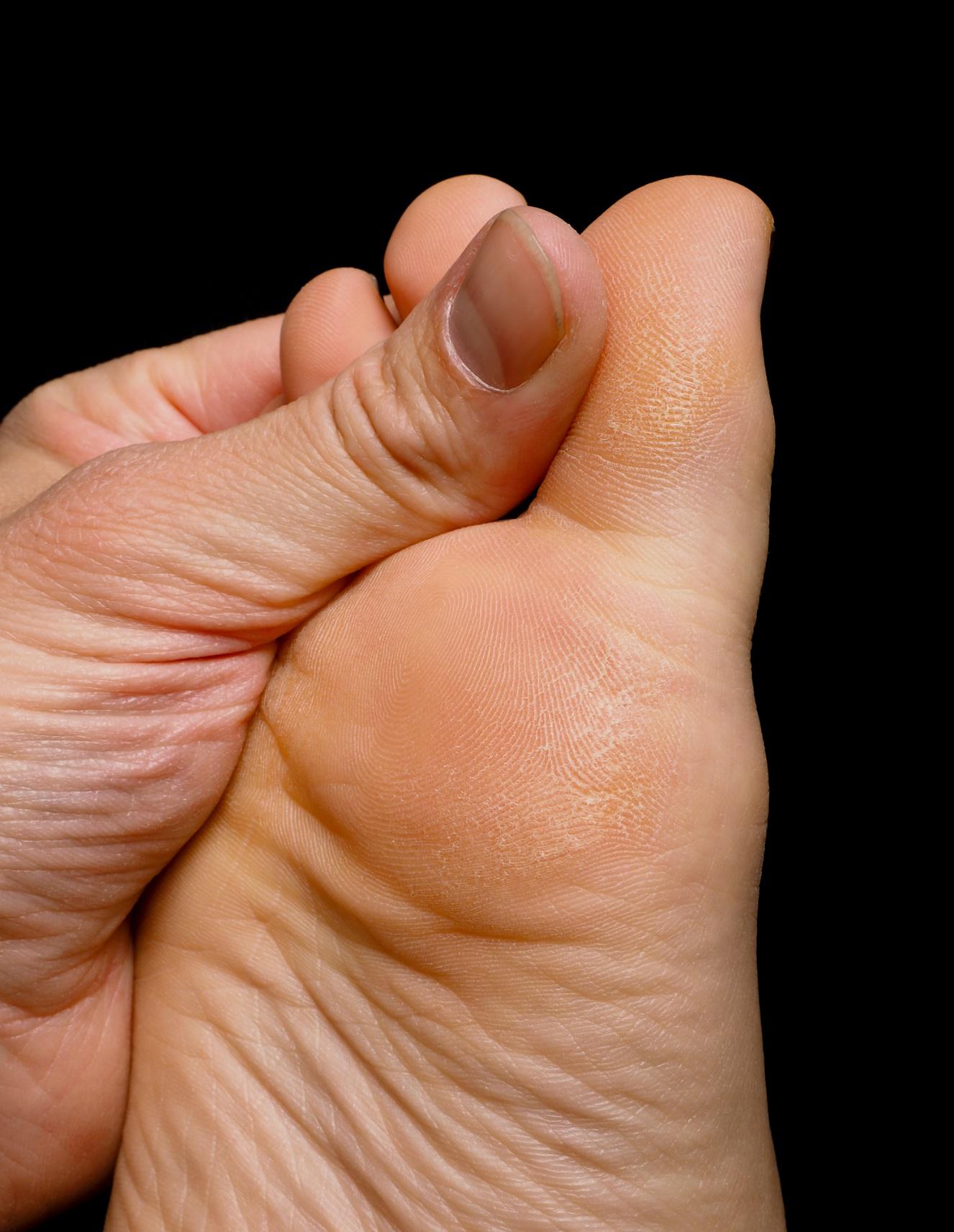 Causes And Treatments For Gout Sarasota Arthritis Center