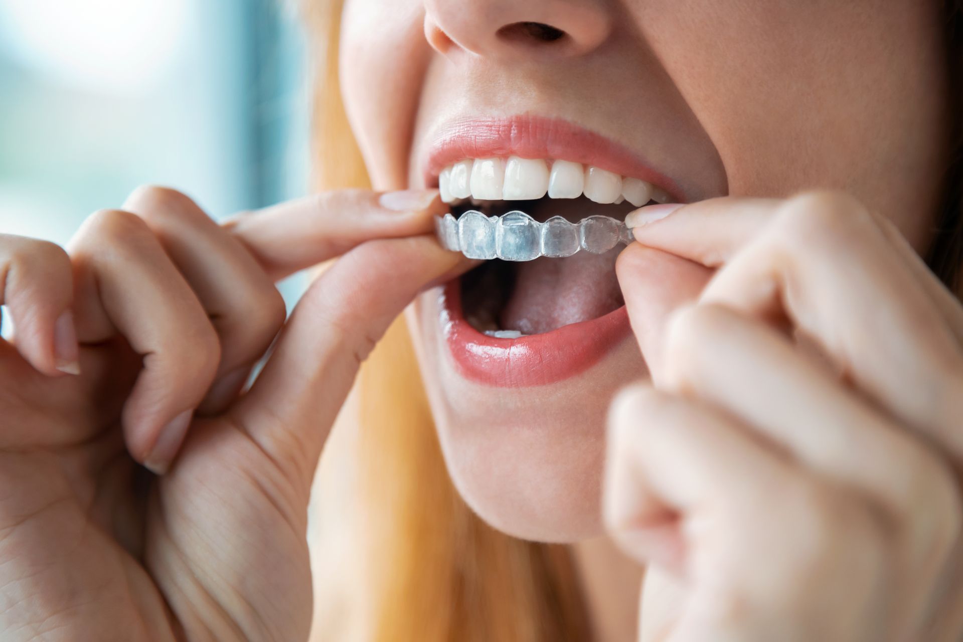 woman inserting a clear aligner onto het top row of teeth.