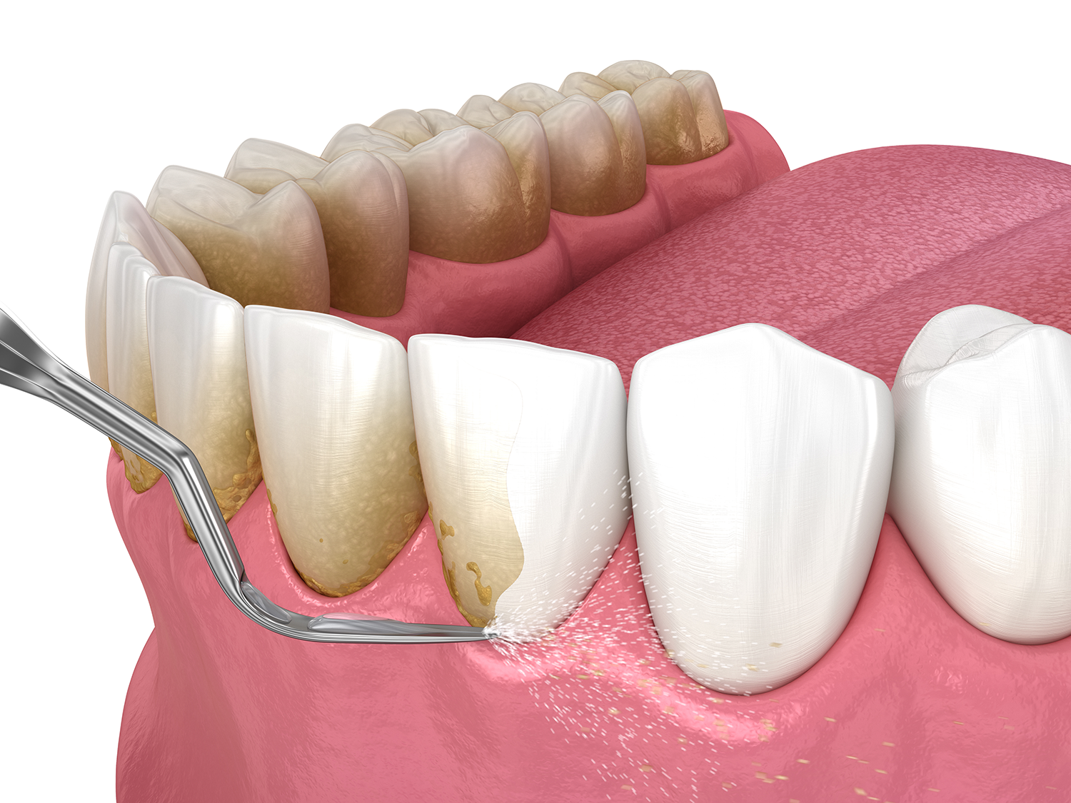 Dental patient getting preventive dentistry care