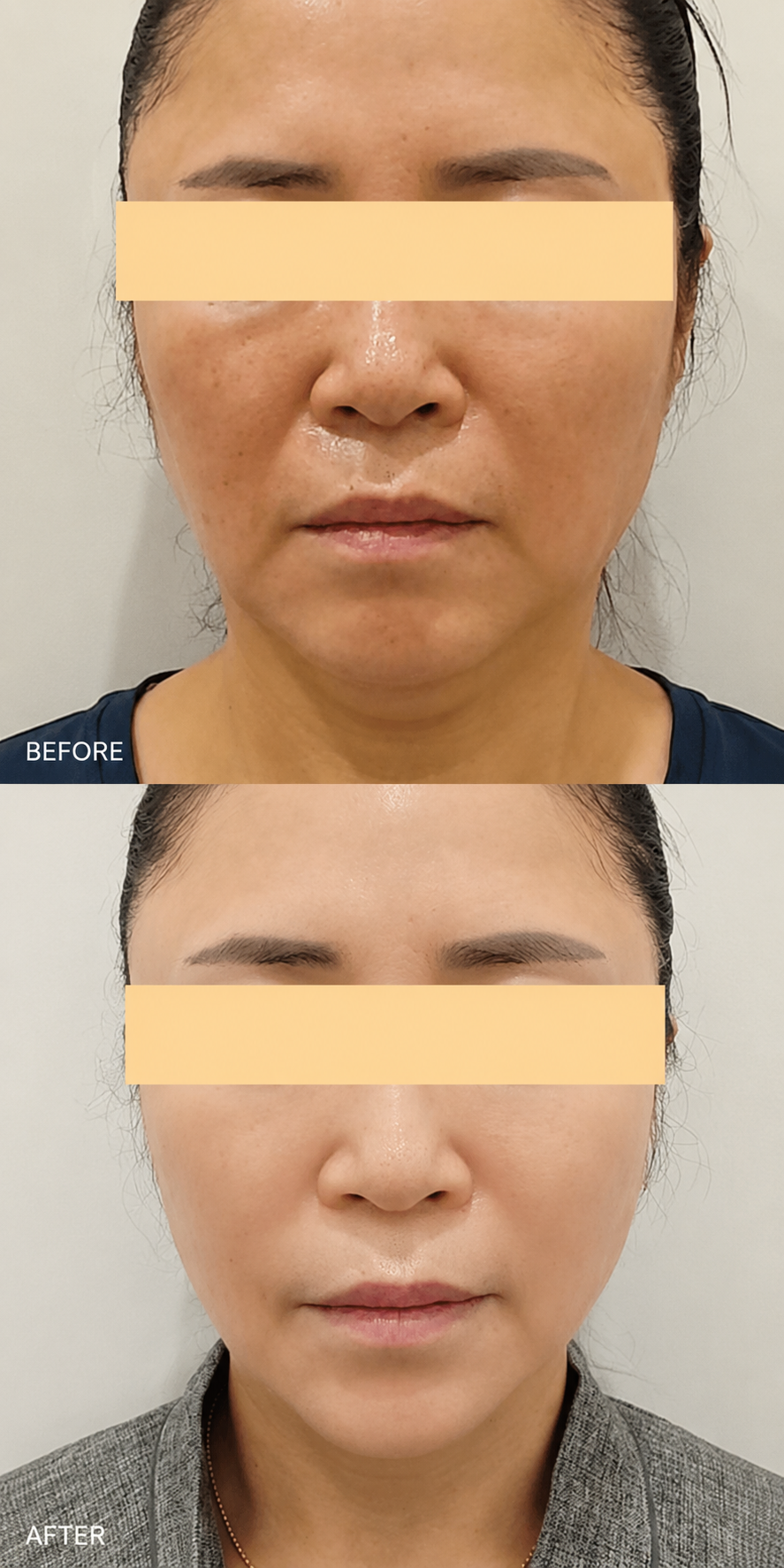 Artner Injection face fat-dissolving before and after at ARTNER Cheongdam Seoul