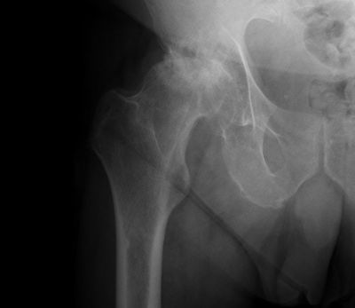 Hip Replacement Surgery 3