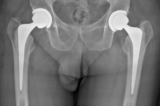 Hip Replacement Surgery 4
