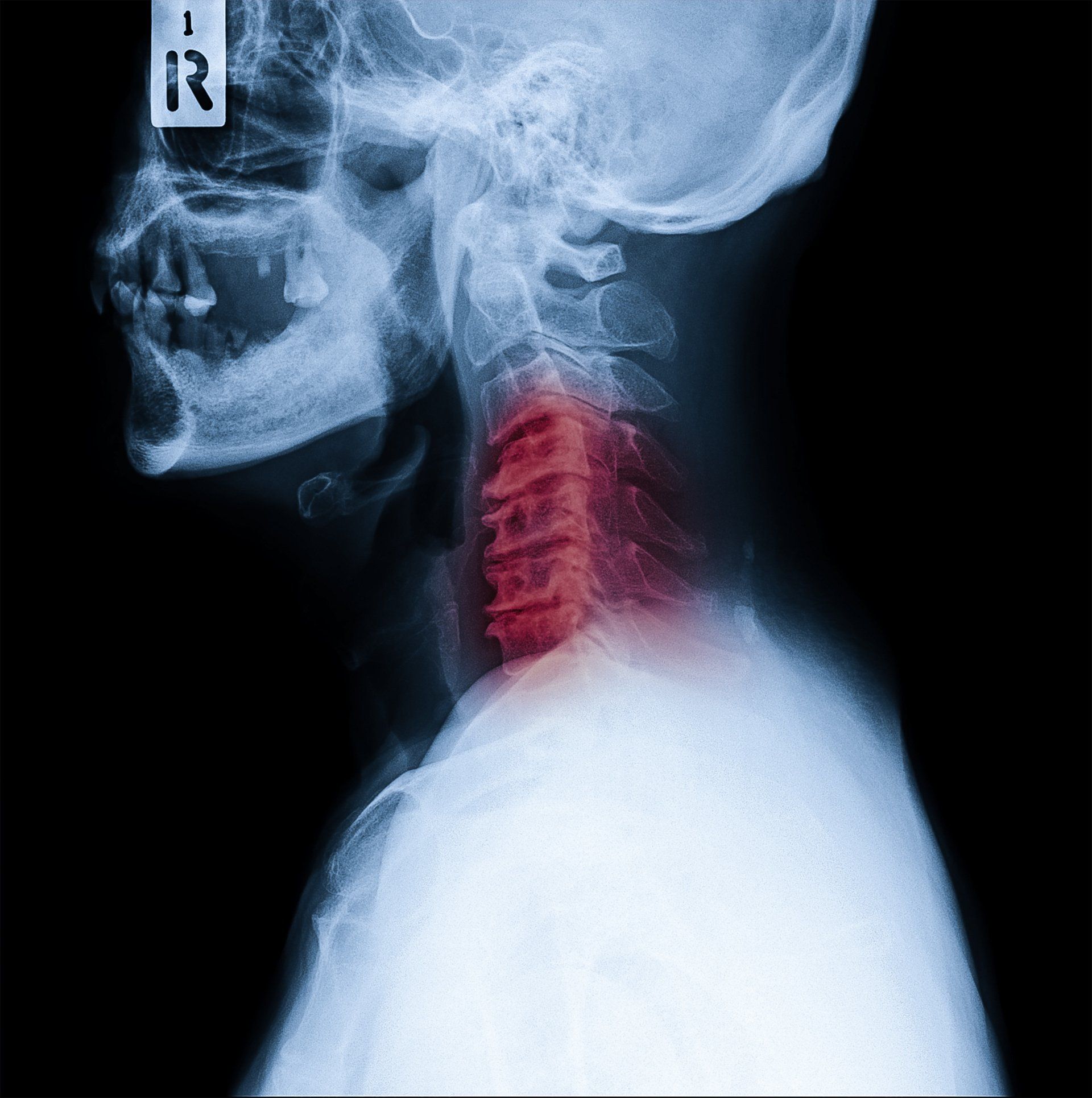 Tratamento para cervicalgia em Nova Iguaçu